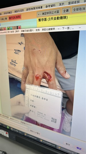 撕裂傷