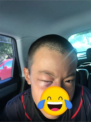 打到眼睛
